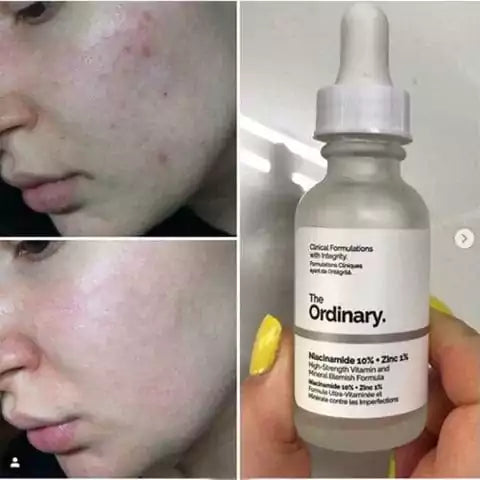 The Ordinary Niacinamide Zinc 30ml